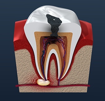 Animation of damaged tooth