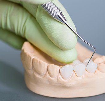 Model smile with fixed bridge restoration