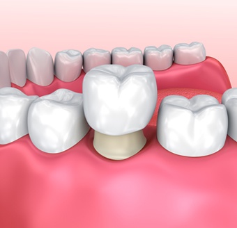 3D image of a crown being put on a tooth 