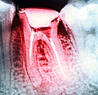 X-ray of damaged tooth