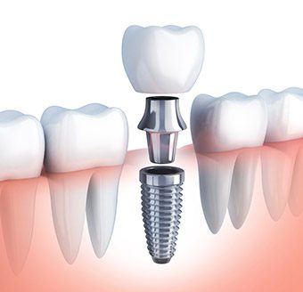 Animation of implant placement