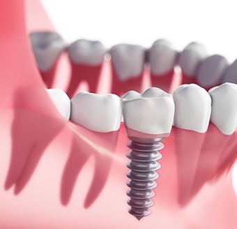 Animation of implant supported dental crown